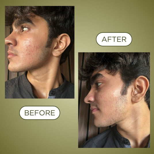 Revive: Acne Exfoliating Care (Face Mask + Nutrition Drink)