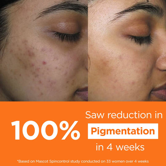 before and after usage of Vitamin C Cream - PRISM