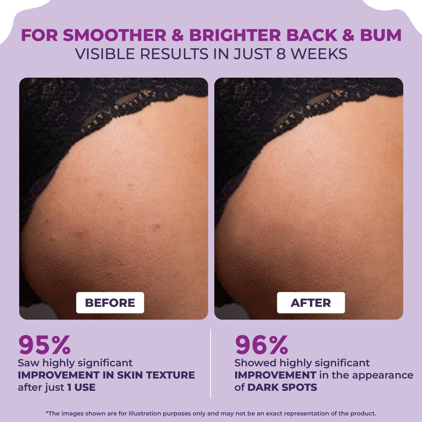 Back and Bum lightening Cream - 200gm