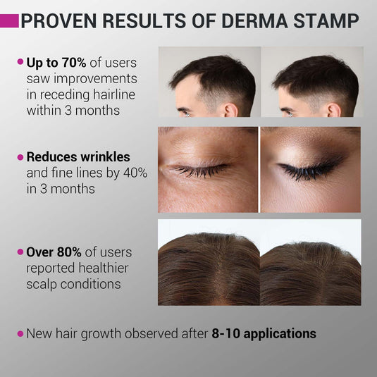 Derma Stamp | Adjustable Stainless Steel Needles - 0.25mm to 3mm