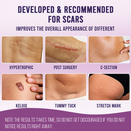 Sanfe Silicone Scar Sheet