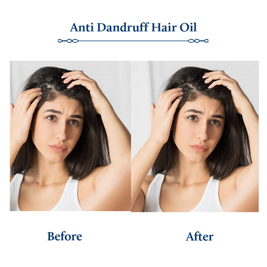 Anti Dandruff Hair Oil 