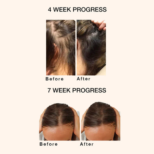 SUPER HAIR REPAIR with Rosemary, Rice Brand and Gingseng Root for hair fall and hair thinning